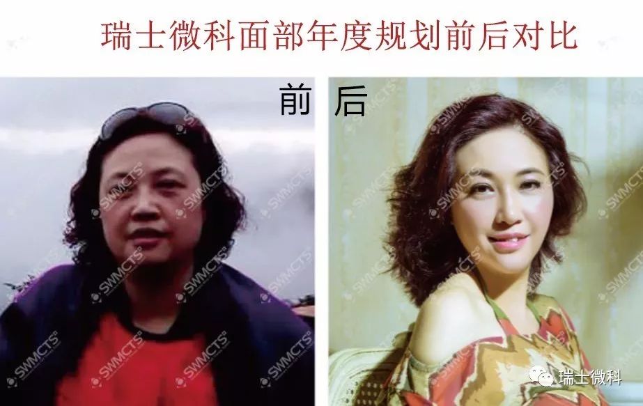 瑞士微科张女士案例分享