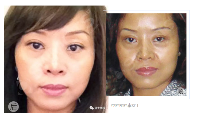 瑞士微科客户案例