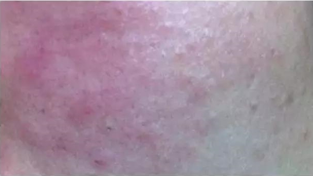 皮肤瘙痒、红肿甚至疼痛的反应，还伴随成片的“痘痘”产生，也就是烂脸